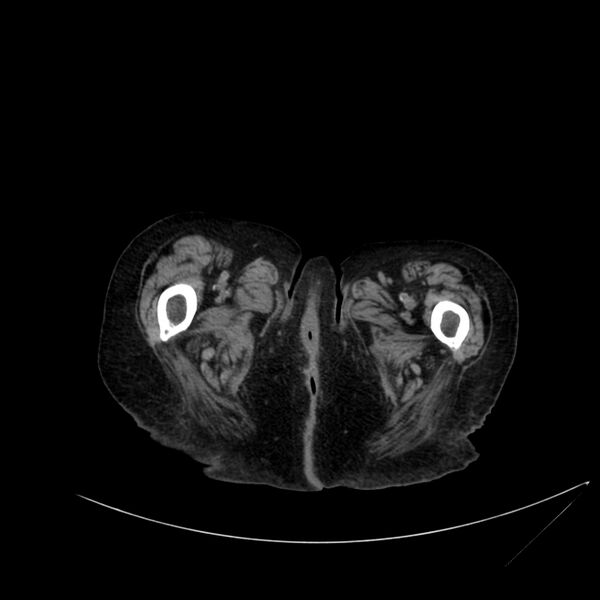 File:Abdominal aortic aneurysm - impending rupture (Radiopaedia 19233-19246 Axial non-contrast 143).jpg
