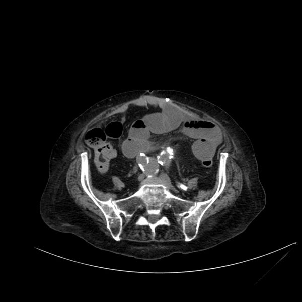 File:Abdominal aortic aneurysm - impending rupture (Radiopaedia 19233-19246 Axial non-contrast 90).jpg