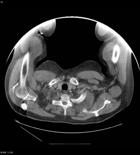 File:Abdominal aortic aneurysm with intramural hematoma then rupture (Radiopaedia 50278-55631 Axial C+ arterial phase 1).jpg