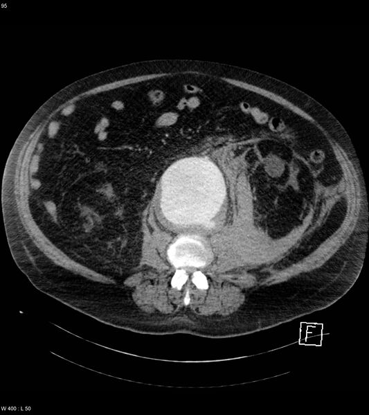 File:Abdominal aortic aneurysm with intramural hematoma then rupture (Radiopaedia 50278-55632 Axial C+ arterial phase 94).jpg