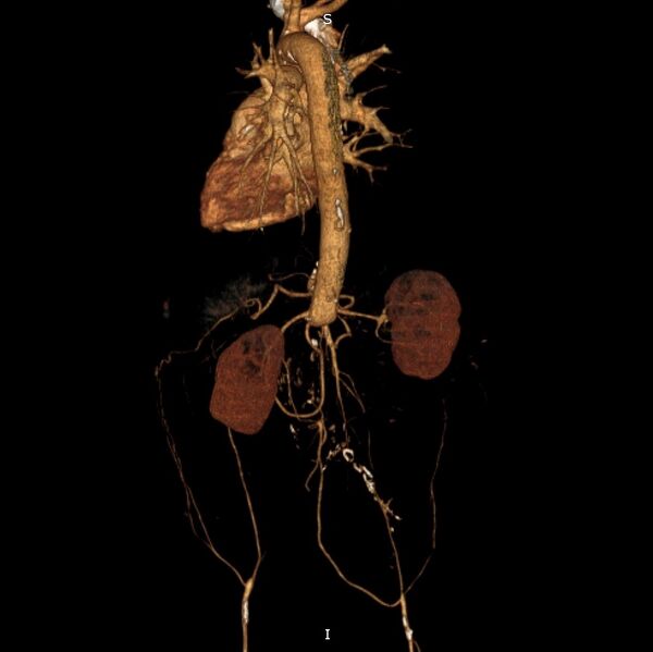 File:Abdominal aortic interposition tube graft and aneurysm thrombosis (Radiopaedia 71438-81857 3D VRT C+ arterial phase 8).jpg