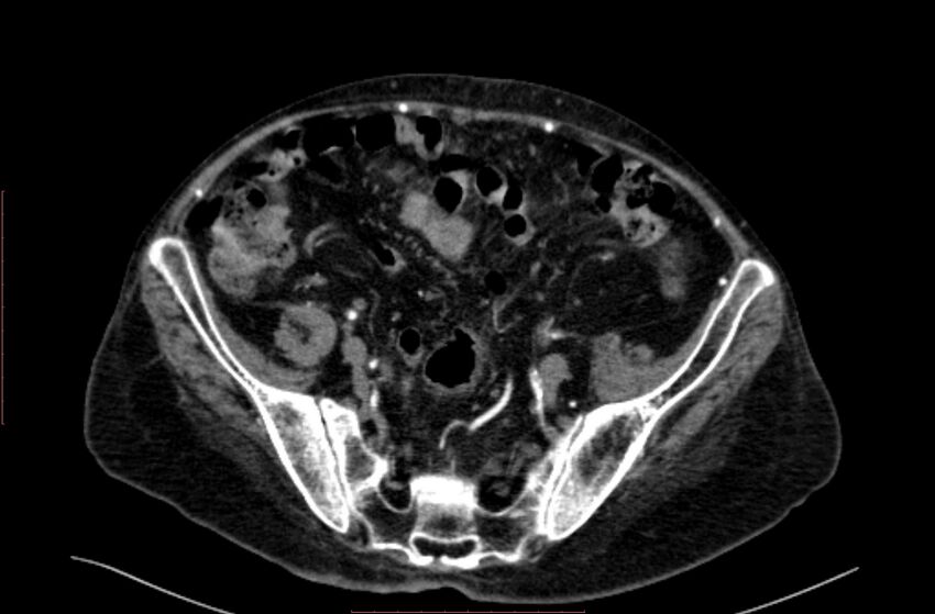 Abdominal aortic interposition tube graft and aneurysm thrombosis (Radiopaedia 71438-81857 Axial C+ arterial phase 171).jpg