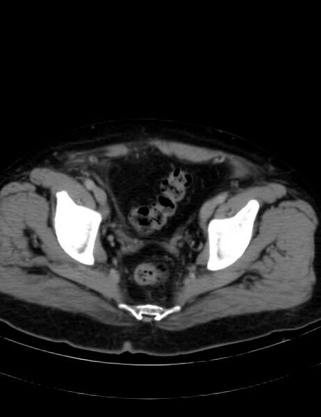 File:Abdominal lymphoma - with sandwich sign (Radiopaedia 53486-59492 Axial C+ portal venous phase 45).jpg