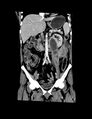 Accessory right inferior hepatic vein (Radiopaedia 33050-34067 Coronal C+ portal venous phase 2).jpg