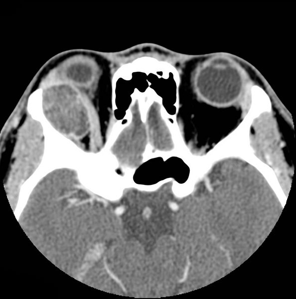 File:Acinic cell carcinoma of the lacrimal gland (Radiopaedia 9480-10160 Axial C+ arterial phase 8).jpg