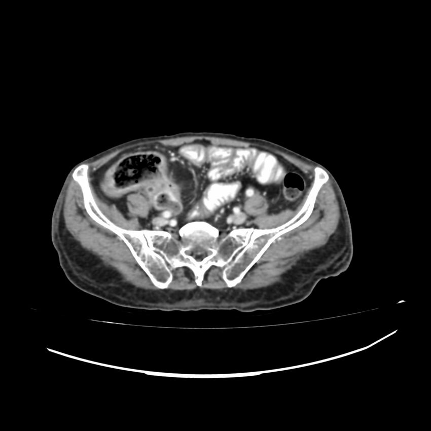 Acute-on-chronic Crohn disease with enteroenteric fistula (Radiopaedia 66686-75987 B 46).jpg