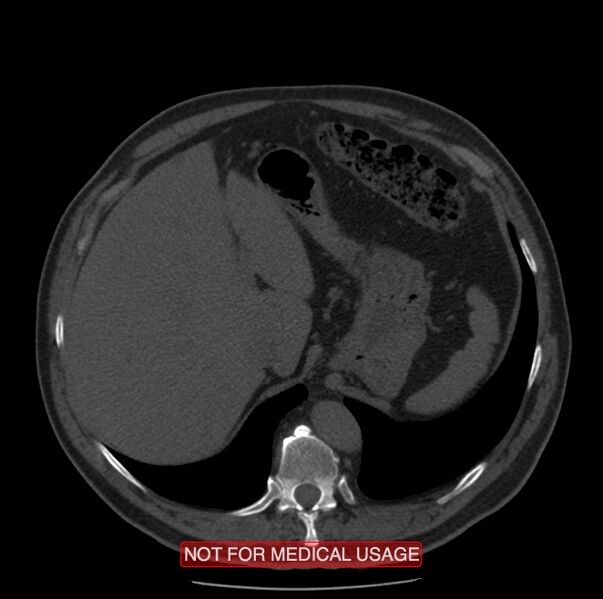 File:Acute aortic dissection - Stanford type A (Radiopaedia 40661-43285 Axial non-contrast 71).jpg