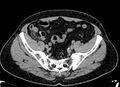 Acute appendicitis (Radiopaedia 13030-13091 Axial non-contrast 59).jpg
