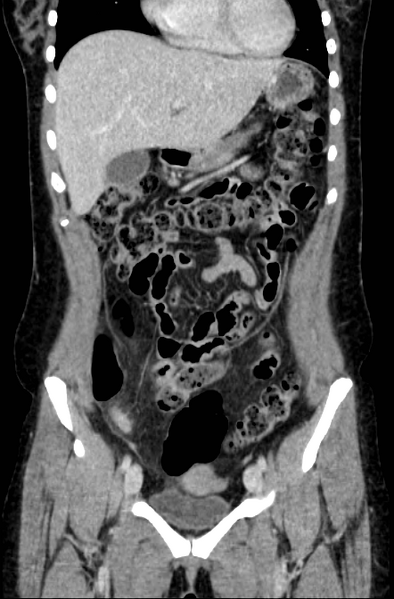 File:Acute appendicitis (Radiopaedia 22892-22918 Coronal C+ portal venous phase 14).png