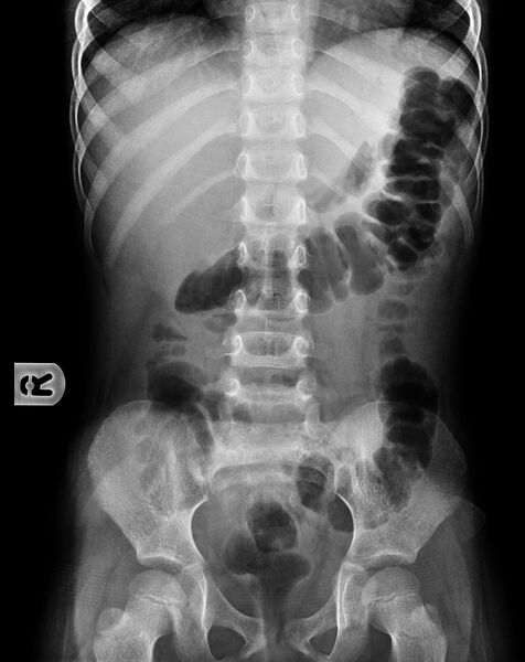 File:Acute appendicitis (Radiopaedia 9308-9992 B 1).jpg