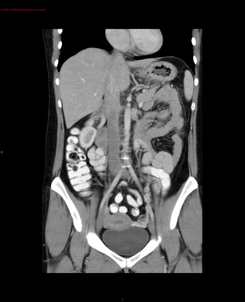 File:Acute gastritis (Radiopaedia 21043-20975 Coronal C+ portal venous phase 14).jpg