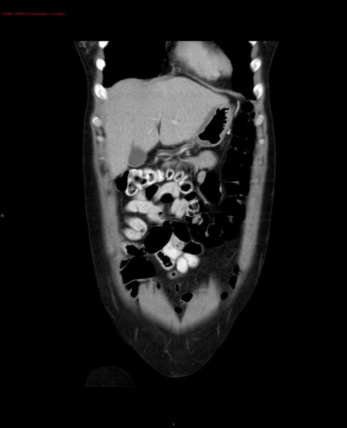 File:Acute gastritis (Radiopaedia 21043-20975 Coronal C+ portal venous phase 24).jpg