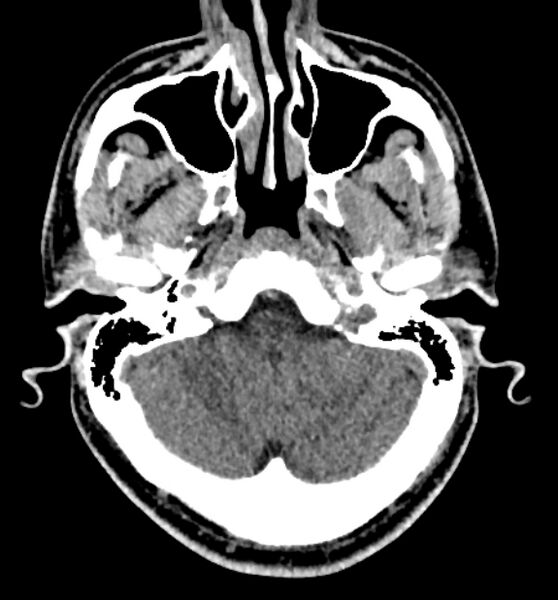 File:Acute ischemic stroke - posterior circulation territory (Radiopaedia 77670-89881 non-contrast 14).jpg