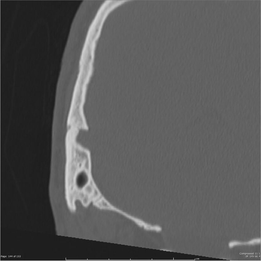 Acute otomastoiditis (Radiopaedia 28276-28512 Coronal PTB bone window reformat 75).jpg