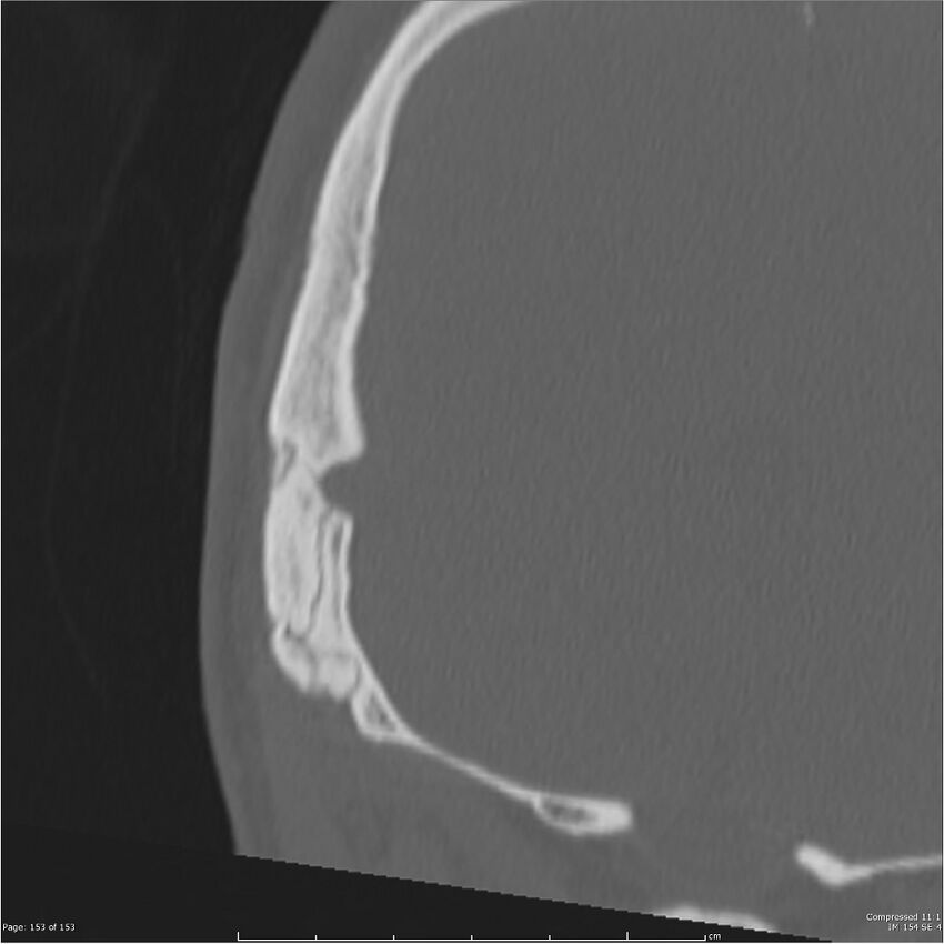 Acute otomastoiditis (Radiopaedia 28276-28512 Coronal PTB bone window reformat 84).jpg