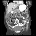 Acute pancreatitis (Radiopaedia 19136-19117 Coronal C+ portal venous phase 12).jpg
