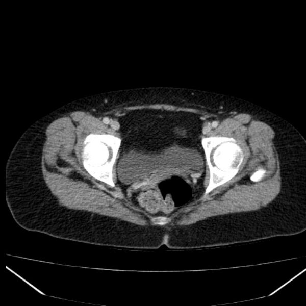 File:Acute pancreatitis - Balthazar C (Radiopaedia 26569-26714 Axial C+ portal venous phase 89).jpg