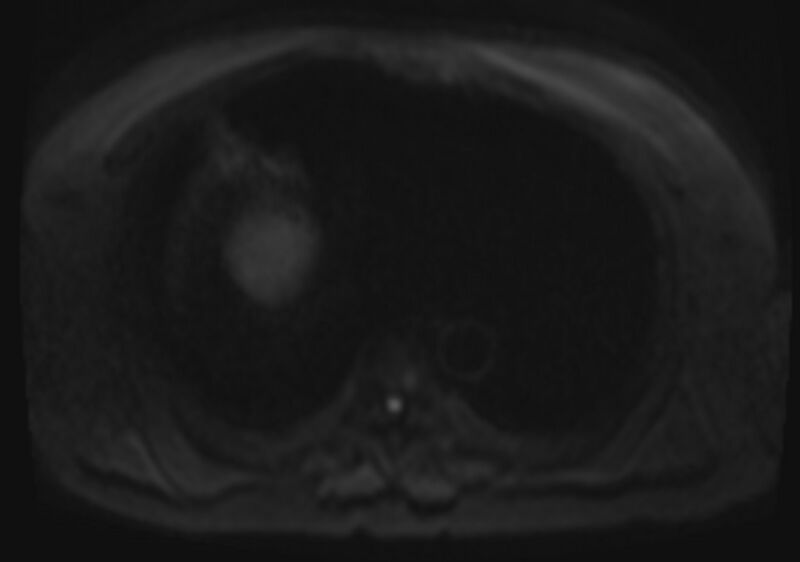 File:Acute portal vein thrombosis (Radiopaedia 73198-83925 Axial DWI 34).jpg