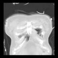 Acute pulmonary edema on CT (Radiopaedia 33582-34672 Coronal lung window 2).jpg