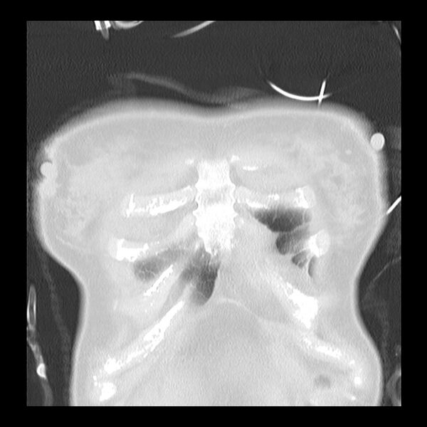 File:Acute pulmonary edema on CT (Radiopaedia 33582-34672 Coronal lung window 2).jpg