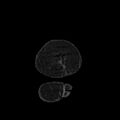 Acute pyelonephritis (Radiopaedia 25657-25837 Coronal renal parenchymal phase 6).jpg