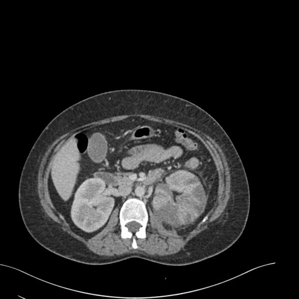 File:Acute pyelonephritis with renal vein thrombosis (Radiopaedia 58020-65053 Axial renal parenchymal phase 60).jpg