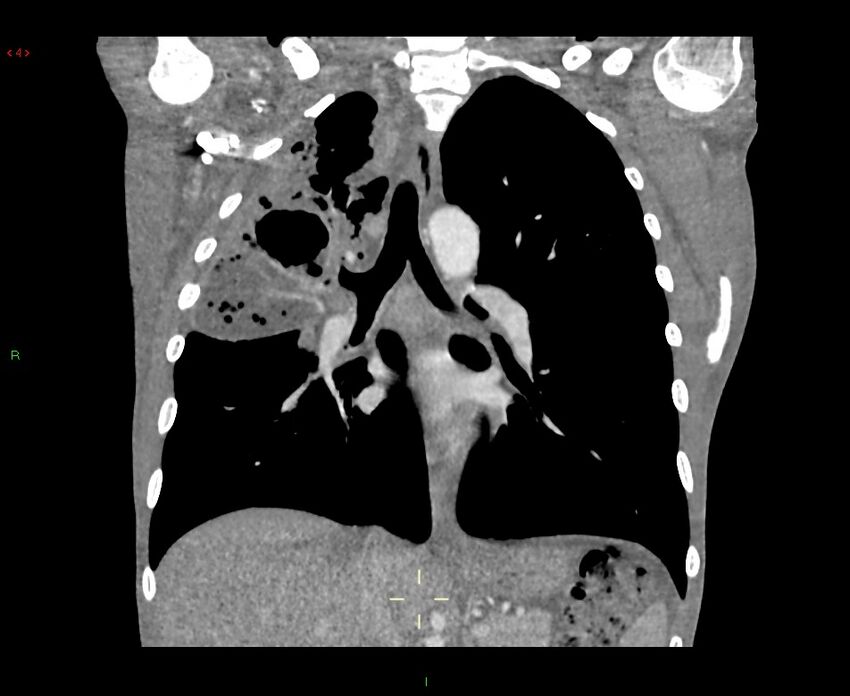 Acute right lung abscess (Radiopaedia 34806-36258 Coronal C+ arterial phase 26).jpg