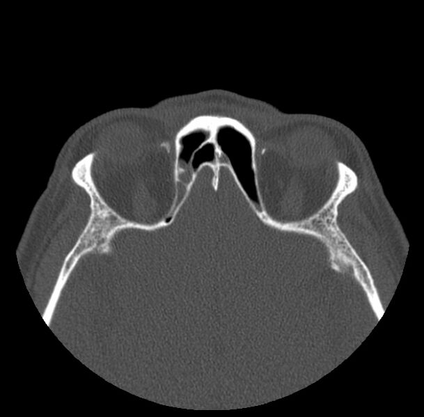 File:Acute sinusitis (Radiopaedia 23161-23215 Axial bone window 58).jpg