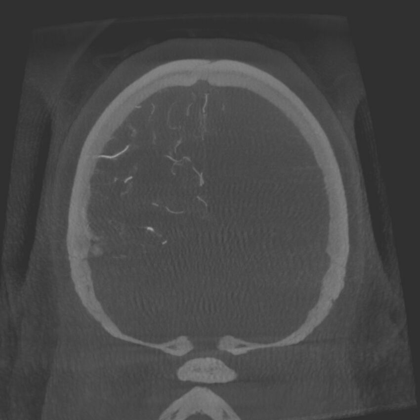 Acute subarachnoid hemorrhage and accessory anterior cerebral artery (Radiopaedia 69231-79010 Coronal arterial - MIP 85).jpg