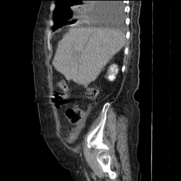 File:Acute tubular necrosis (Radiopaedia 28077-28334 H 23).jpg