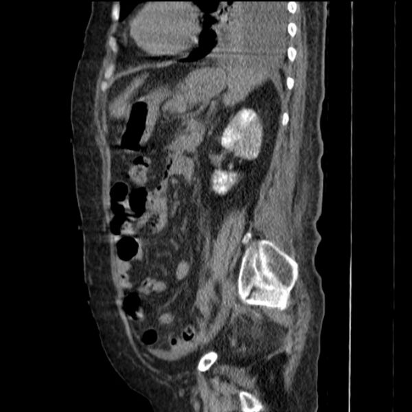 File:Acute tubular necrosis (Radiopaedia 28077-28334 H 59).jpg