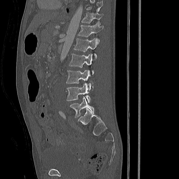 File:Acute vertebral body compression fractures (Radiopaedia 31757-32693 Sagittal bone window 17).jpg