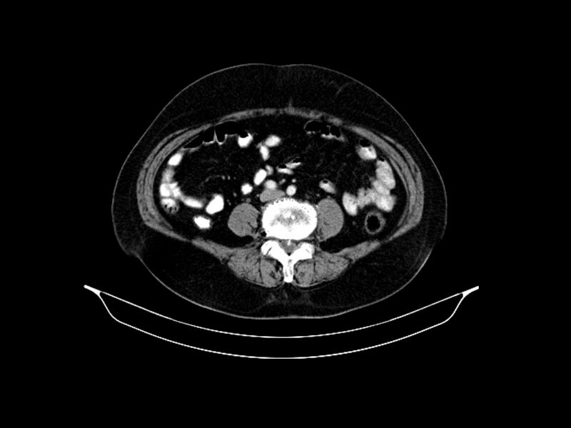 File:Adenocarcinoma of pancreas with hepatic metastasis (Radiopaedia 64332-73122 Axial C+ portal venous phase 66).jpg