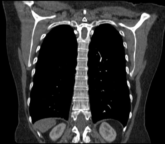 File:Adenocarcinoma of the lung (Radiopaedia 44205-47803 Coronal C+ portal venous phase 75).jpg