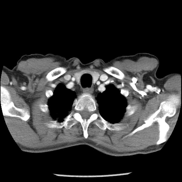 File:Adenocarcinoma of the lung - micropapillary predominant (Radiopaedia 42446-45563 Axial C+ portal venous phase 6).jpg