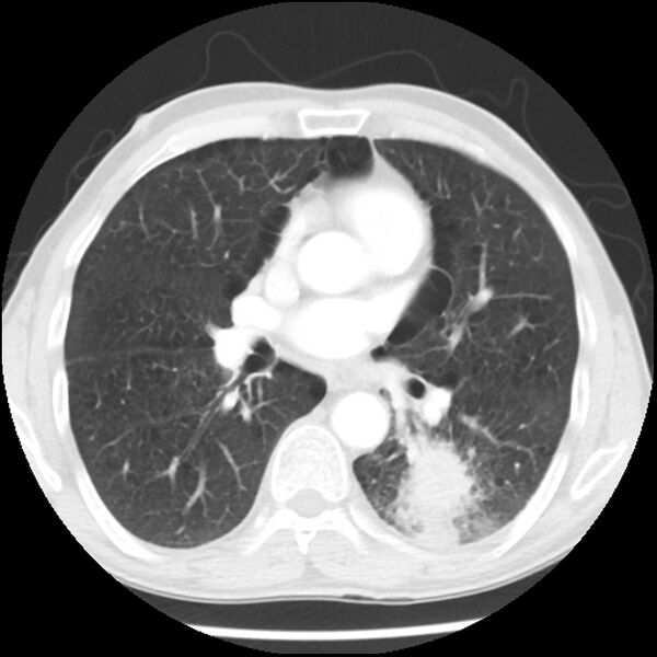 File:Adenocarcinoma of the lung - micropapillary predominant (Radiopaedia 42446-45563 Axial lung window 38).jpg