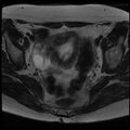 Adenoma malignum of the cervix (Radiopaedia 24460-24765 C 8).jpg