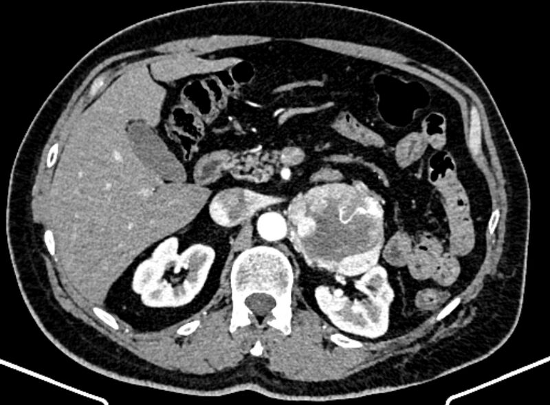 File:Adrenal metastases (Radiopaedia 73082-83791 Axial C+ arterial phase 60).jpg