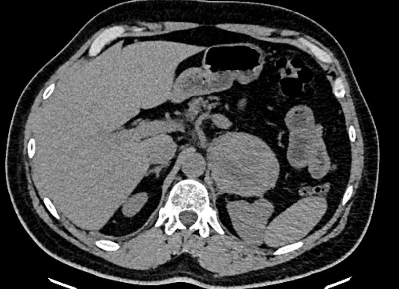 File:Adrenal metastases (Radiopaedia 73082-83791 Axial non-contrast 49).jpg