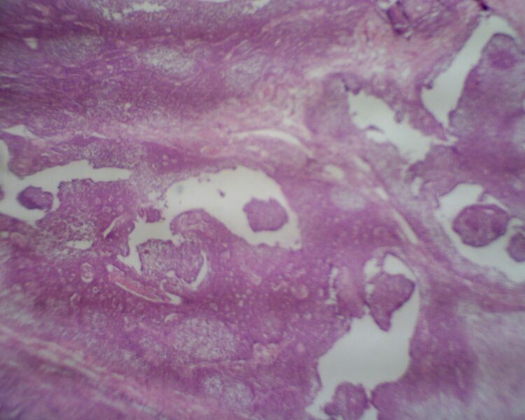 File:Adult granulosa cell tumor of the ovary (Radiopaedia 64991-74394 B 1).jpg