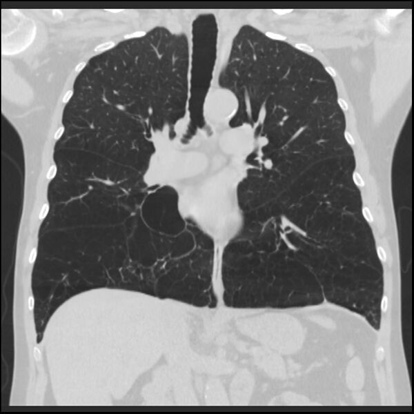 File:Alpha-1-antitrypsin deficiency (Radiopaedia 40993-43722 Coronal lung window 51).jpg