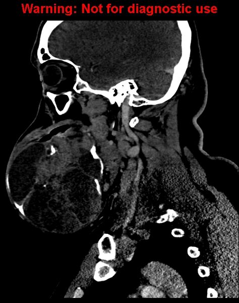 File:Ameloblastoma (Radiopaedia 33126-34164 F 25).jpg