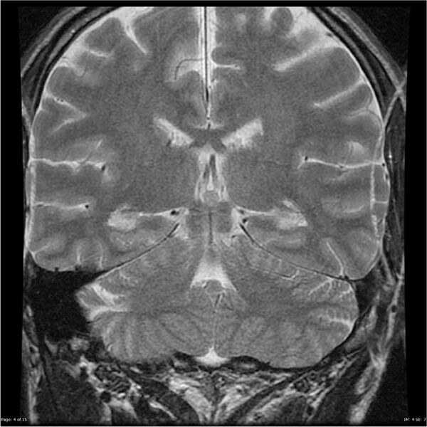 File:Amnestic syndrome secondary to hypoxic brain injury (Radiopaedia 24743-25004 F 4).jpg