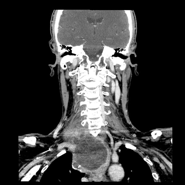 File:Anaplastic thyroid carcinoma (Radiopaedia 79087-92034 A 73).jpg