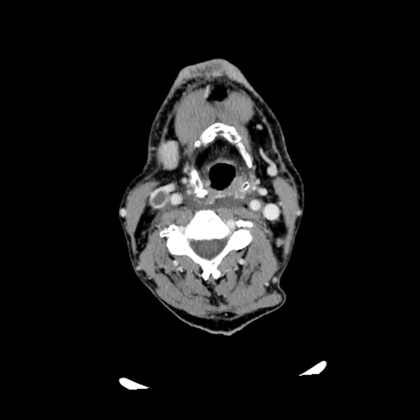 Anaplastic thyroid carcinoma (Radiopaedia 79087-92034 B 71).jpg