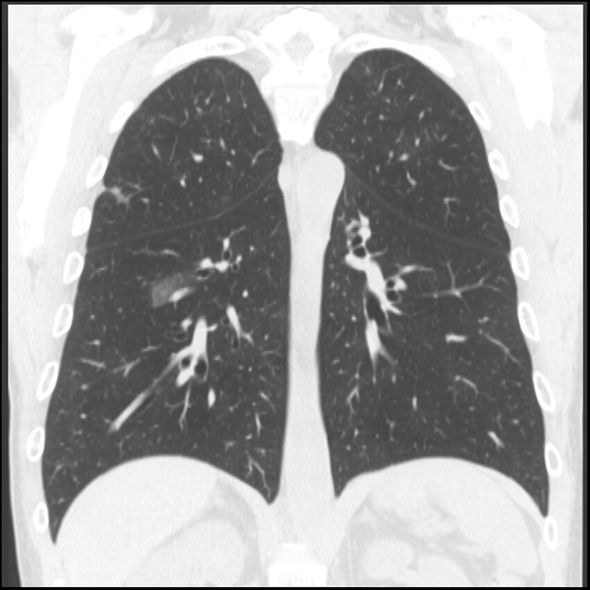 Angioinvasive aspergillosis (Radiopaedia 43957-47466 Coronal lung window 35).jpg