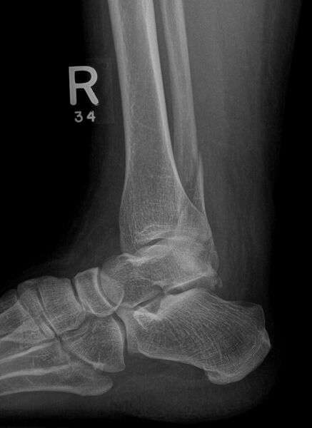File:Ankle fracture - Weber C (Radiopaedia 10965-11383 Oblique 1).jpg