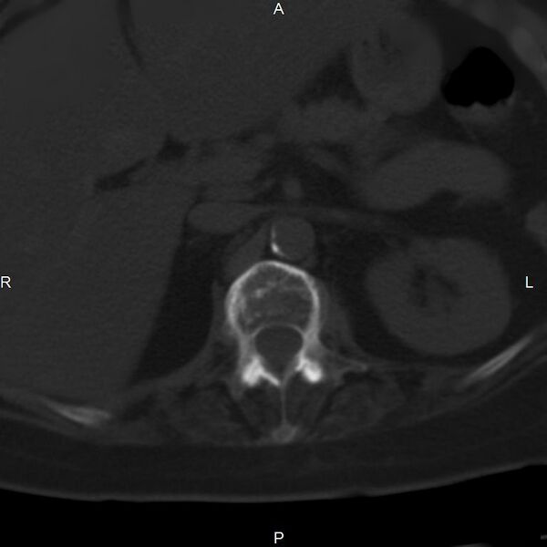 File:Ankylosing spondylitis (Radiopaedia 8748-9556 Axial bone window 20).jpg