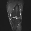 Anterior cruciate ligament full thickness tear (Radiopaedia 66268-75467 Coronal STIR 7).jpg