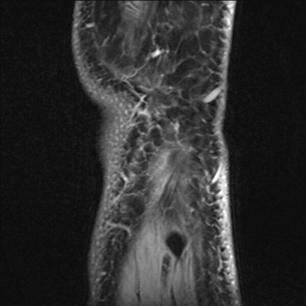 File:Anterior cruciate ligament tear - ramp lesion (Radiopaedia 71883-82322 Sagittal T1 vibe 10).jpg